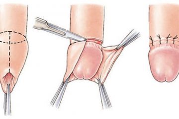 Cắt bao quy đầu là gì – Lợi ích, quy trình thực hiện