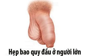 [Hẹp bao quy đầu ở người lớn] Nguyên nhân, triệu chứng và cách điều trị