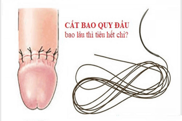 [Chuyên gia giải đáp] Cắt bao quy đầu bao lâu thì tiêu hết chỉ?