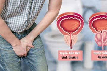 Viêm tuyến tiền liệt là gì – Dấu hiệu, nguyên nhân & cách điều trị