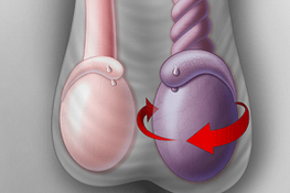 Xoắn tinh hoàn: Nguyên nhân, triệu chứng và cách điều trị
