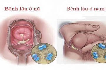 Tổng quan nguyên nhân, dấu hiệu và cách chữa bệnh lậu