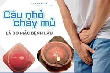 Dương vật chảy mủ 90% bạn đã mắc bệnh lậu