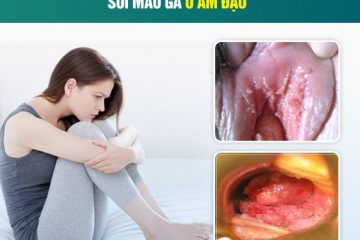 Điều cần biết về bệnh sùi mào gà ở âm đạo nữ giới