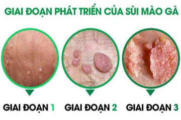 [Cách nhận biết] Sùi mào gà giai đoạn đầu ở nam và nữ