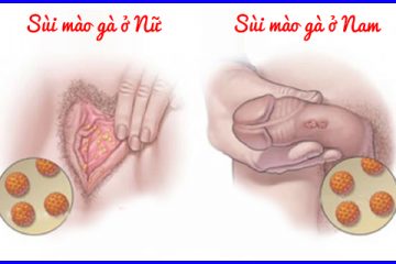 [Bật mí]: Dấu hiệu nhận biết sùi mào gà ở nam và nữ giới