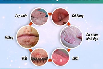 Biểu hiện sùi mào gà ở cơ quan sinh dục nam, nữ, hậu môn, miệng lưỡi