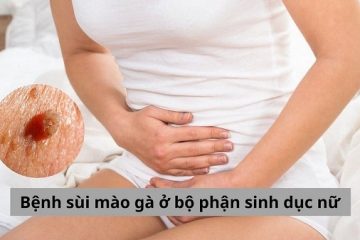 [Giải đáp] Vì sao phụ nữ dễ mắc sùi mào gà ở vùng kín?